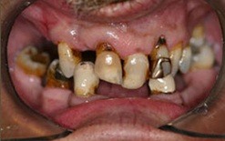 implant patient 6 before