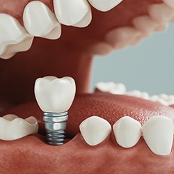 A digital image of a customized crown sitting on top of an implant placed in the lower arch of the mouth