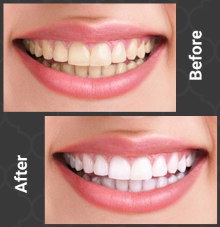 patient 2 before and after whitening