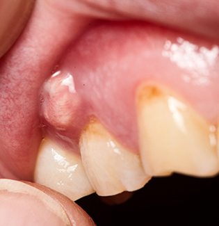 bump on a person’s gum caused by an infected tooth