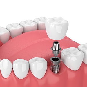 dental implant in Fayetteville