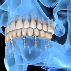 A digital scan of a skull complete with an implant denture on the lower arch