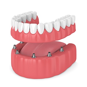 Render of full implant dentures in Fayetteville, NC with six implant posts