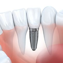 Single dental implant in Fayetteville, NC in lower arch