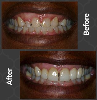 patient with crown lengthening
