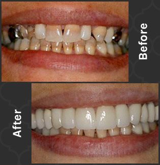 patient smile before and after veneers