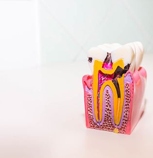model of a tooth that has been infected