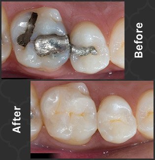 comparison of tooth colored fillings and silver filling