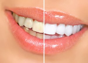 woman before and after teeth whitening
