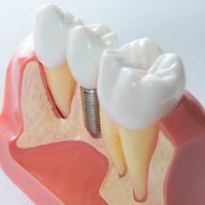 Model of a dental implant replacing a lost tooth